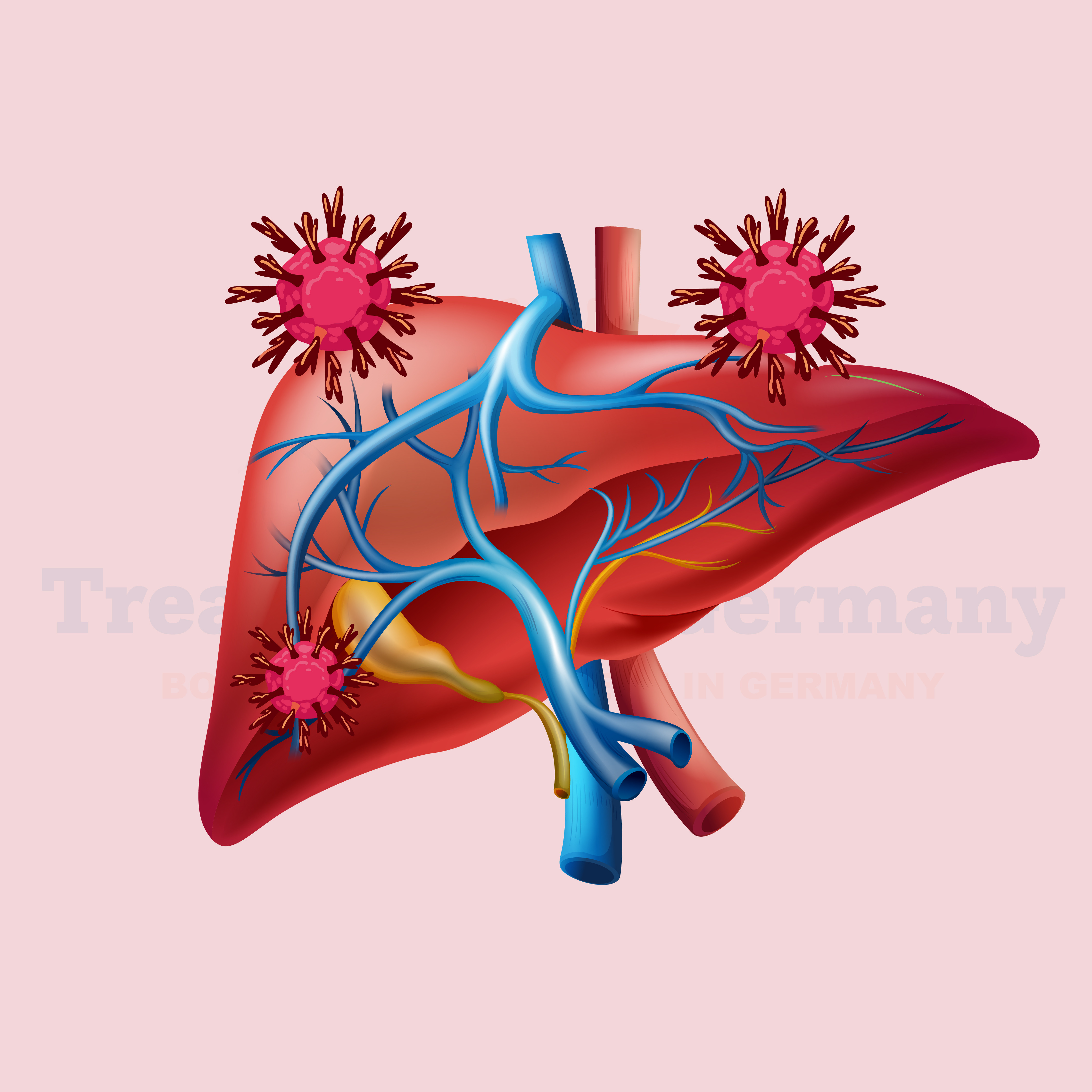 Pancreatic Cancer