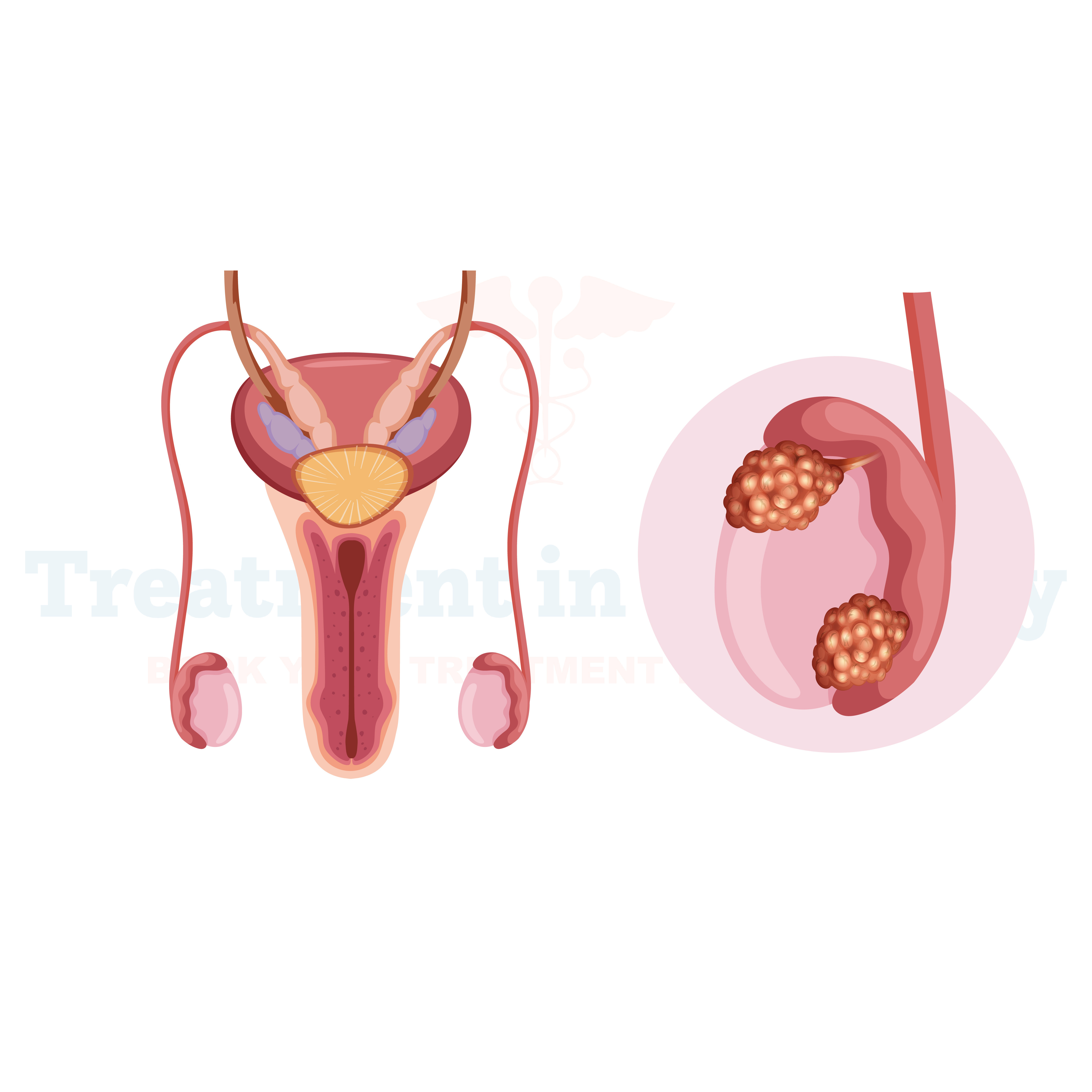 Testicular Cancer