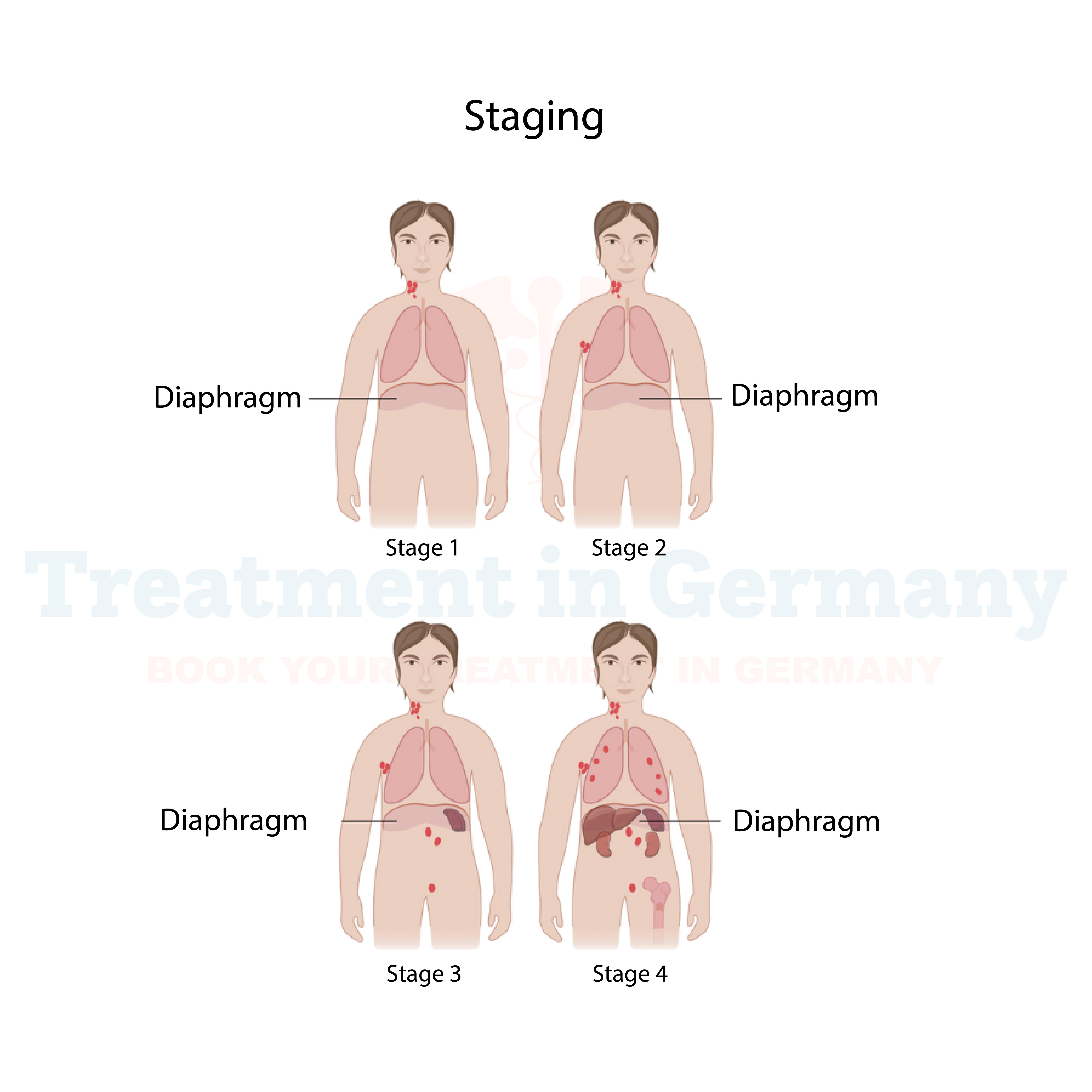 Lymphoma
