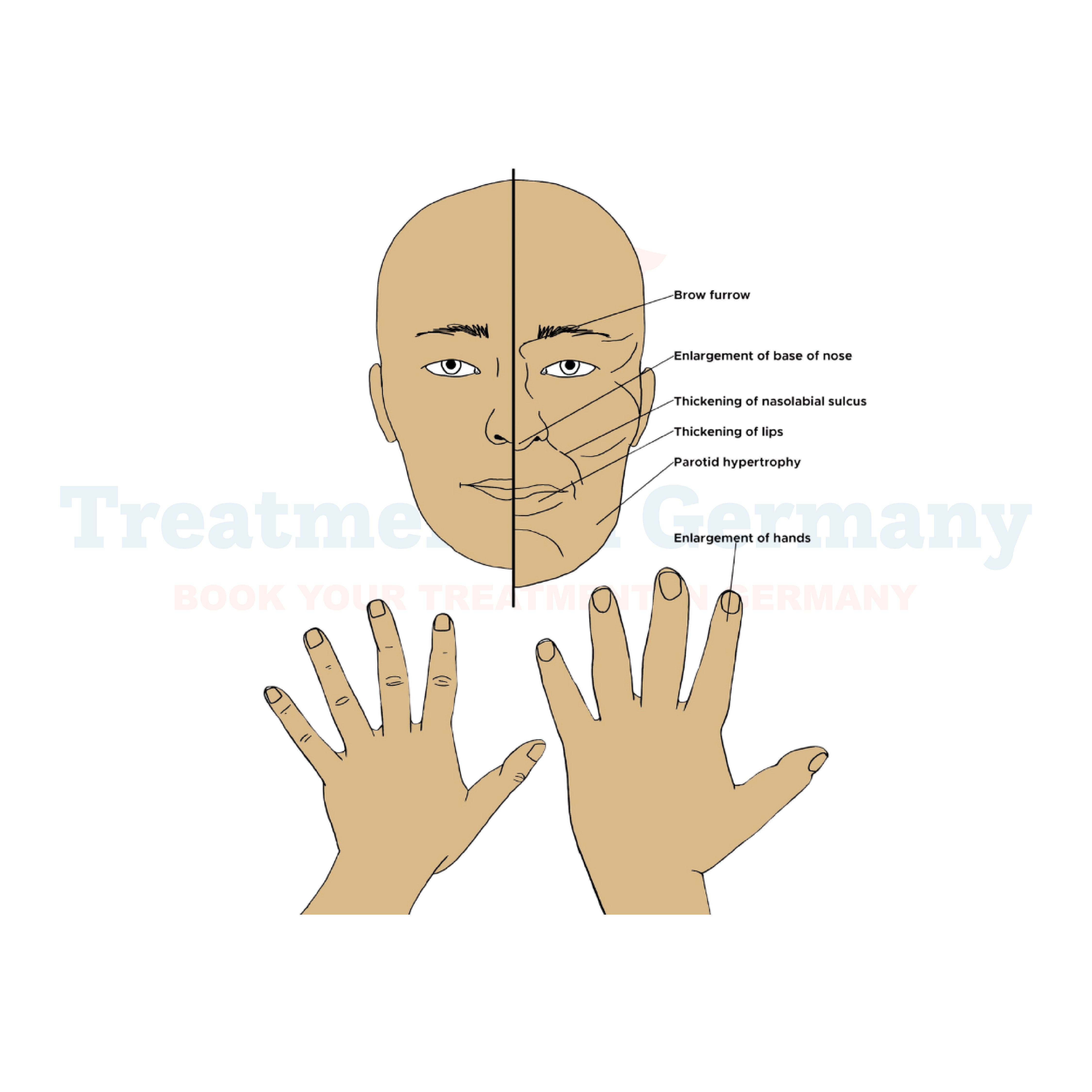 Acromegaly