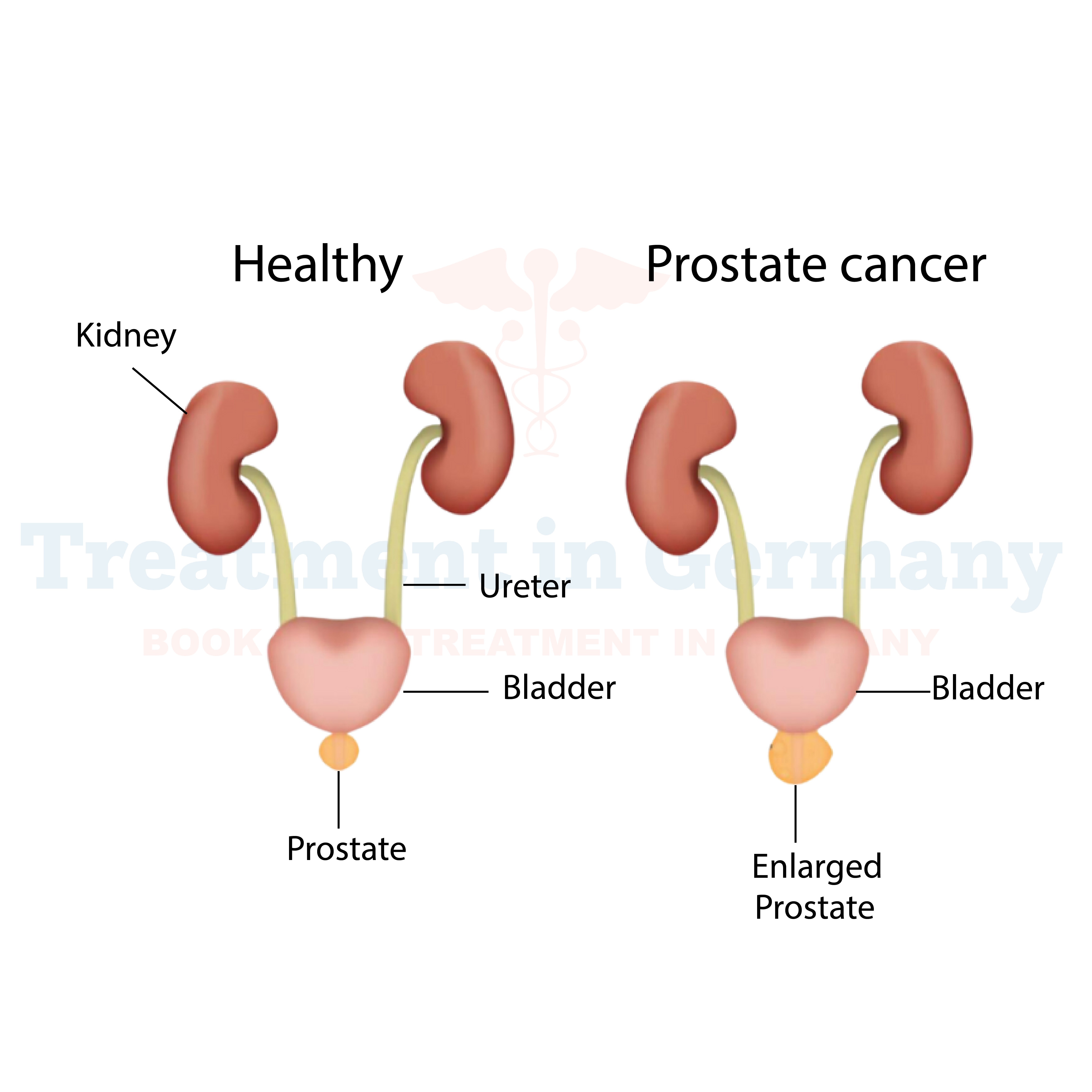 Prostate Cancer