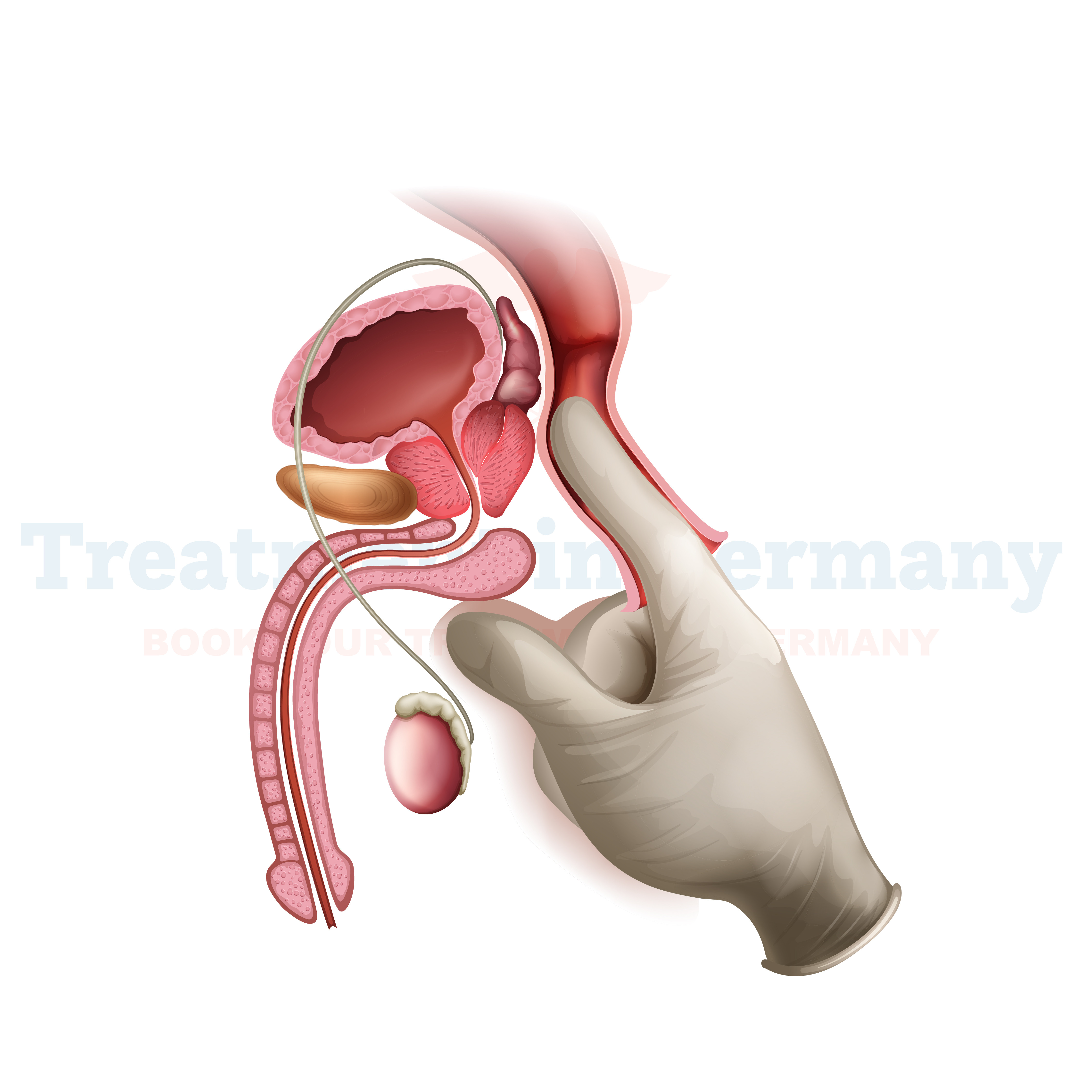Penile Cancer