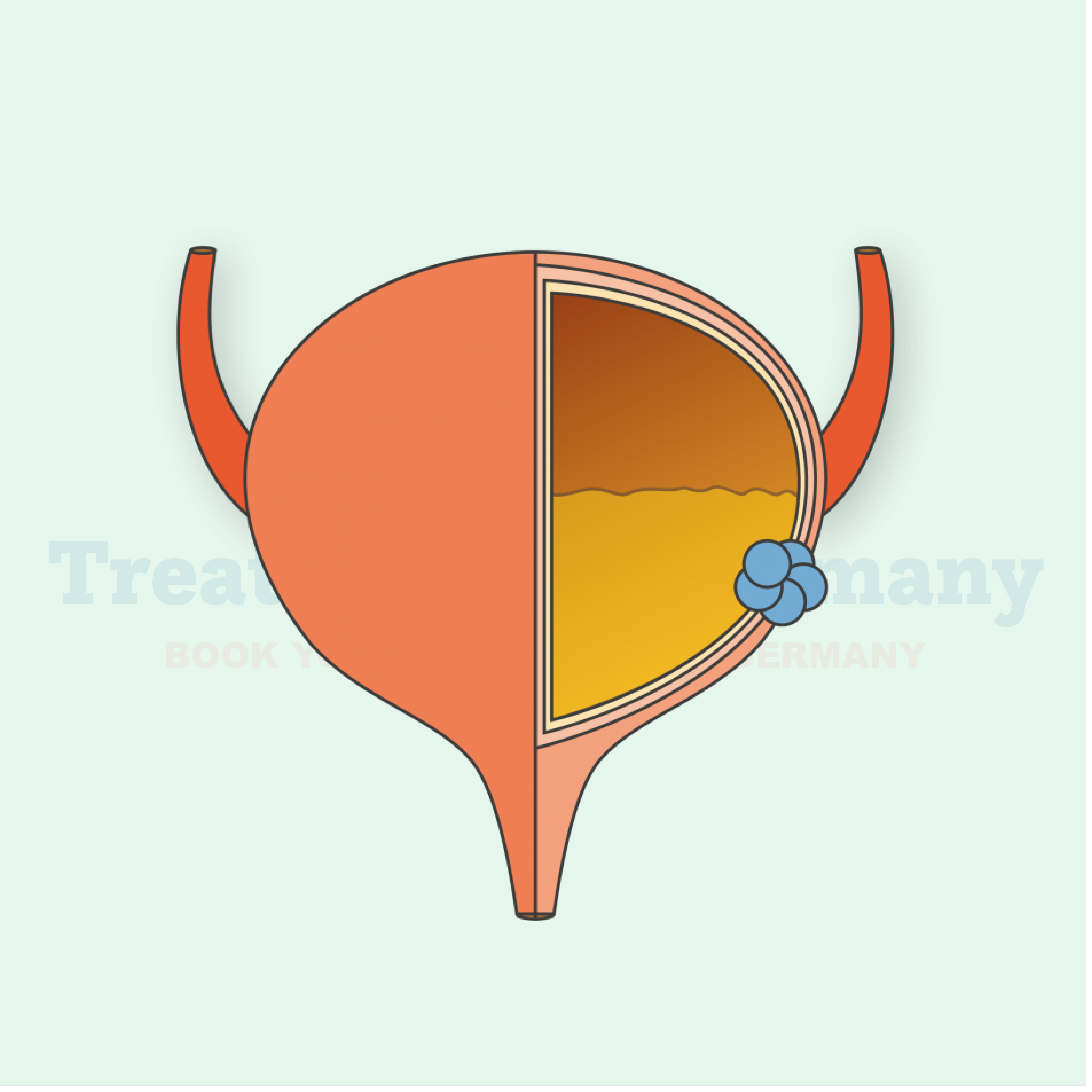 Bladder Cancer