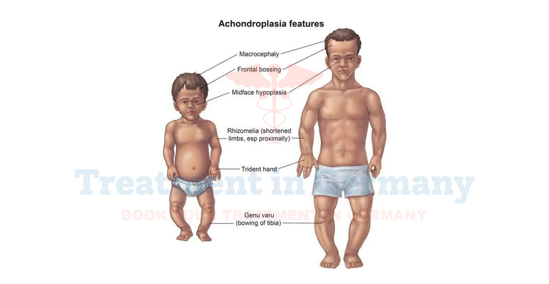 Achondroplasia